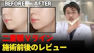 【施術前後】手軽に二重顎をなくしV ラインを作る方法！【ラミチェ皮膚科】