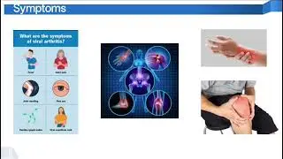 Viral Arthritis | Joint Pain After Viral Fever?