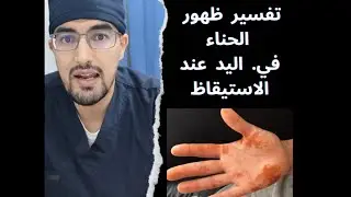 ما سبب ظهور بقع الحناء على اليد عند الاستيقاظ؟ 🤔 الدكتور قادري مصعب