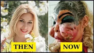 13 Disastrous Plastic Surgeries of Celebrities Before and After THEN NOW | Then and Now 2025