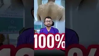 Is there an age for pityriasis versicolor? | સફેદ દાગ નું કારણ શું હોઈ શકે ? | #shorts #skincare