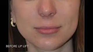 Lip Lift Patient Shares Her Experience: From Surgery Day to One Week Post-Op with Dr. Parfitt