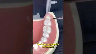 &iquest;Como se hace una extracci&oacute;n de una muela del juicio enterrada?