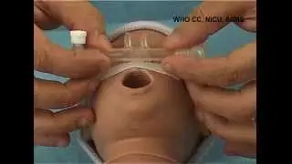 CPAP interface Fixation   Dr Ahok Deorari & Dr Anu Thukral