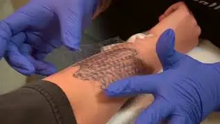 Tatt2Away Treatment Procedure Walkthrough