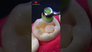 Пломбирование зубов