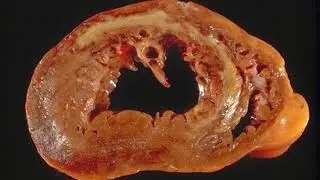 coagulative necrosis heart gross and microscopic features for medical students