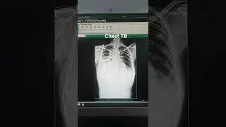 Digital x-ray Chest #Chest#x-ray Chest#Rediography#Rediology#