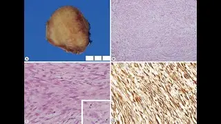 Postoperative spindle cell nodules; benign non cancerous growths that can appear after surgery