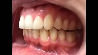 Fastbraces  - Palm Beach, Florida - Dr Nilsa Toledo