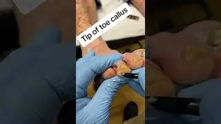 Satisfying Foot Transformation: Pro Podiatrist Toe Callus Removal #FootCare #Podiatry