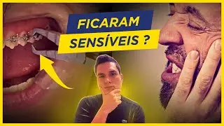 DENTES FICARAM SENSÍVEIS APÓS A REMOÇÃO DO APARELHO ORTODÔNTICO…E AGORA? TEM JEITO?