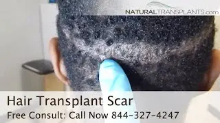 African American Hair Transplant Scar with Dr Kevin Blumenthal