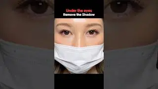 The Secret to Youthful Eyes: Under-Eye Fat Repositioning