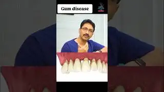 Laser treatment ✅ best for gum diseases #trending #viralvideo #dentalvideo #dentistry #nellore