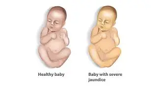 Jaundice: Pediatric Expert Advice from Dr. Little at Greeneville Pediatrics