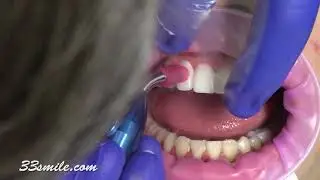 prepless veneers before and after cosmetic dentistry