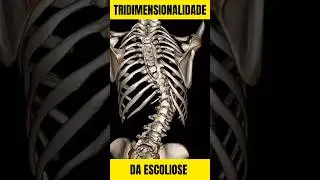 ESCOLIOSE - o que &eacute;?