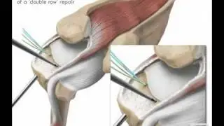 Rotator cuff repair of large massive U tear with releases shoulderdoc.mov