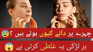 Larkiyon Ke Chehre Par Dane Kyun Hote Hain? | Acne Causes, Periods, Skin Care Tips | Doctor Advice
