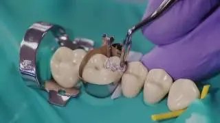 Compound Class II Dental Amalgam  Preparation and Restoration
