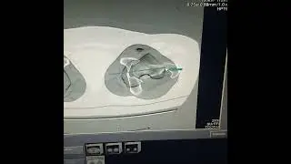 Ct Scanogram (Antiversion Angle) Lower Limbe - اشعه مقطعيه لقياس زوايا الطرفين السلفيين