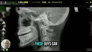 Atlas Orthogonal Chiropractic: Posterior Ponticus presentation