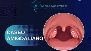 C&aacute;seos Amigdalianos | bolas brancas e malcheirosas nas am&iacute;gdalas causando desconforto e mau h&aacute;lito
