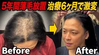 【AGA治療6ヶ月】5年間放置した薄毛が激変！薬を飲みながらお酒は大丈夫！？