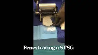 Meshing a Split-Thickness Skin Graft: Why It&rsquo;s Done!