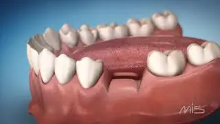 Dental Implant Stoppers by MIS (3D Medical Animation)
