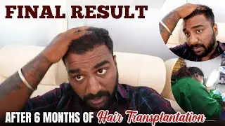 Revealing My Hair Transplant Clinic💁🏻&zwj;♂️🤩 | Cherry Vlogs