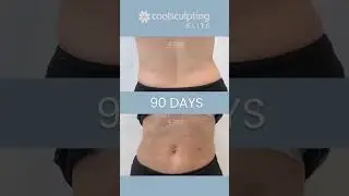 #coolsculpting #доипосле #результатыcoolsculpting #доипосле #результаты #замораживаниежира