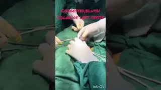 Emergency scrotal exploration | torsion of testis |