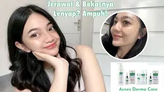 SKIN CARE KHUSUS KULIT BERJERAWAT & SENSITIVE! | Acnes Derma Care Review 💚