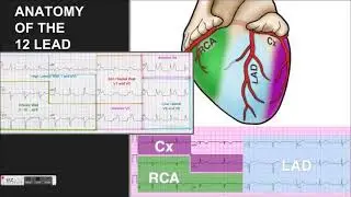 What is a STEMI, really? Part 1