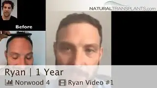 Balding Man Hair Transplant Before and After - 12 Months | Dr. Matt Huebner (Ryan)