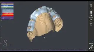 Review gingivectomy guide