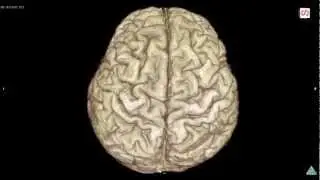Variation of brain cortex 3D MRI sample X,tox