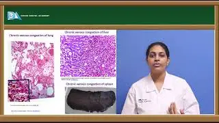 Hyperemia & Adaptive disorders of growth | General Pathology | Indian Dental Academy
