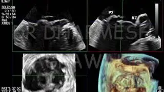 3D TOE MItral Valve navigation Philips Epiq CVx X8