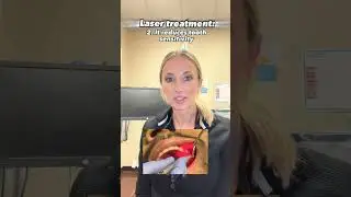 Laser treatment explained🤩