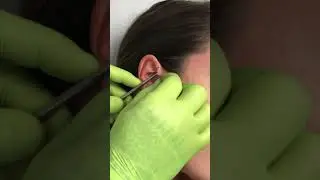 Anti helix piercing