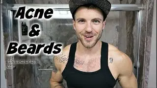 Dealing With Acne- FTM Beards Ep. 03: