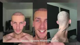 Il percorso di Jakub | Trapianto di capelli Aratravel & Dr. Serkan Aygin