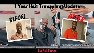My 12-Month Hair Transplant From 15 Years Bald  to Hair Turkey (Asli Tarcan Clinic)