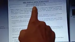 MRI Scan for Back Pain | MRI Scan D12 Vertebrae Compression