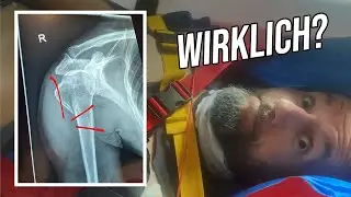 Mein Oberarm hat jetzt 7 Teile