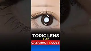 Toric Lens for Cataract Surgery Cost
