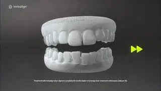 Invisalign Aligners for Teens - Sandhurst Family Dental Clinic - Toronto Family Dentists